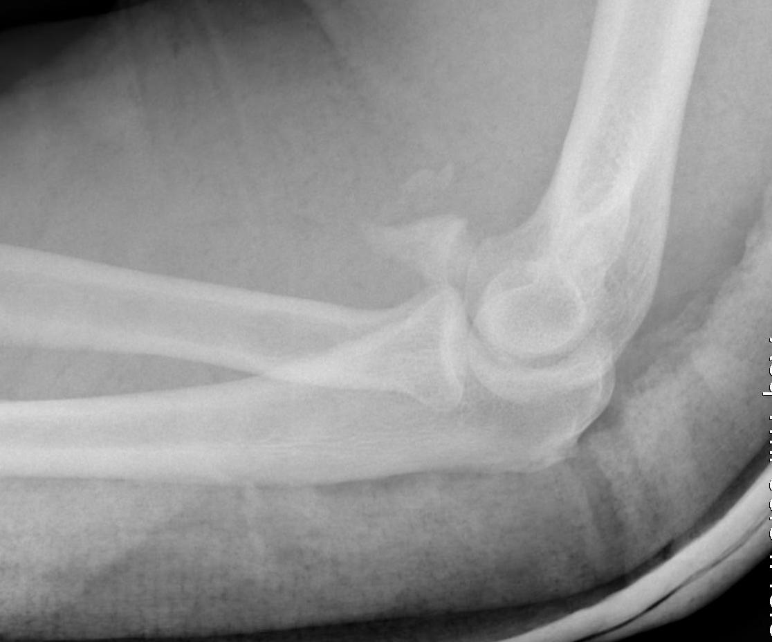 Elbow Dislocation Large Coronoid Fragment 2